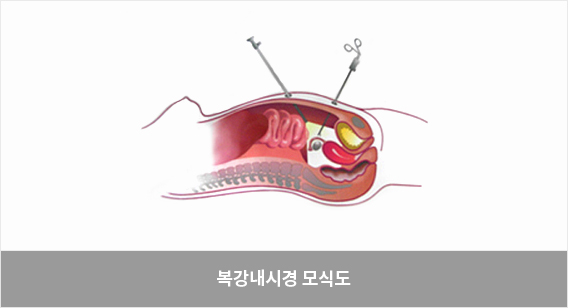 임신성당뇨